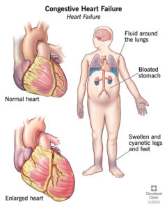 graphic of heart failure