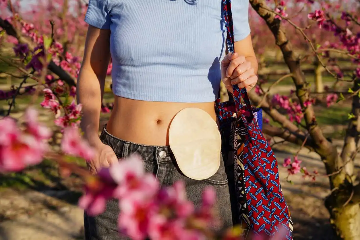 Female stomach with stoma bag amongst flowers