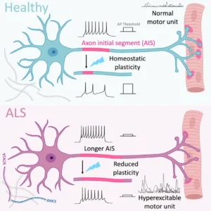 healthy and ALS neurone