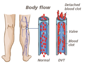 picture of what a DVT looks like