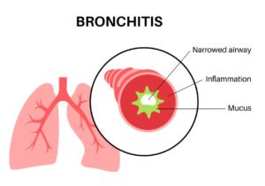 picture of lungs infected with bronchititis